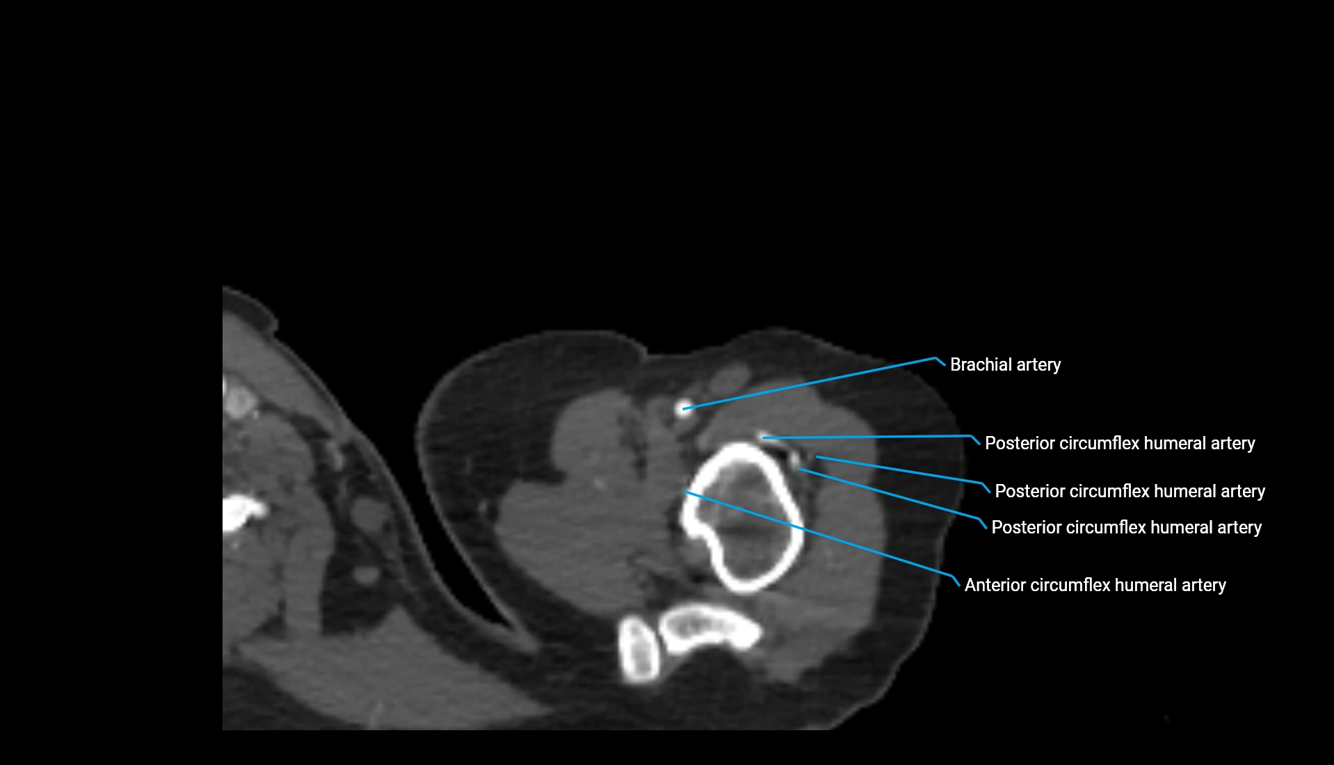 CTA upper limb axial cross sectional anatomy labelled image 315 (1).webp